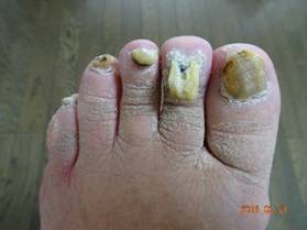 爪切り 施術前 左足