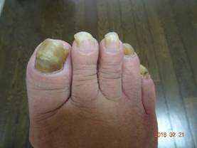 爪切り 施術前 右足