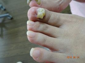 爪切り・爪削り 施術前（外側から見た左足）