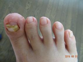 爪切り・爪削り 施術後（右足）