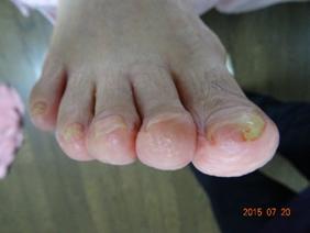 巻き爪矯正（右足）
